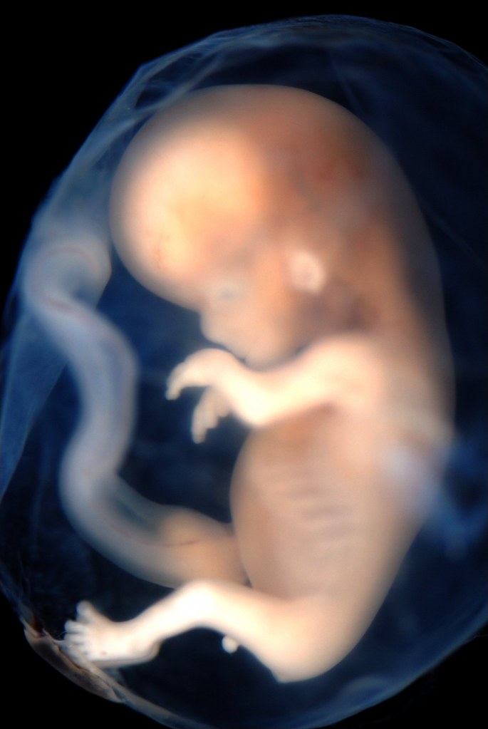 Photo of 9-week fetus from Lunar Caustic used by permission of Creative Commons. 